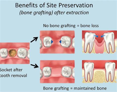 Oral Surgery – Bone grafts - Dallas Dental - Dallas, GA