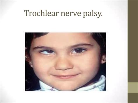 Cranial nerve iii , iv and vi | PPTX