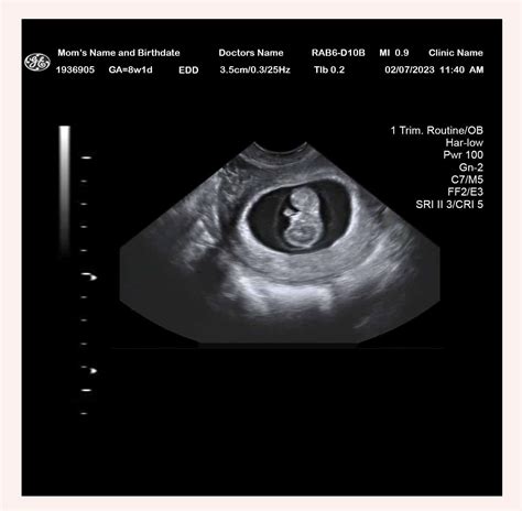 8 Week Ultrasound - Ultrasounds