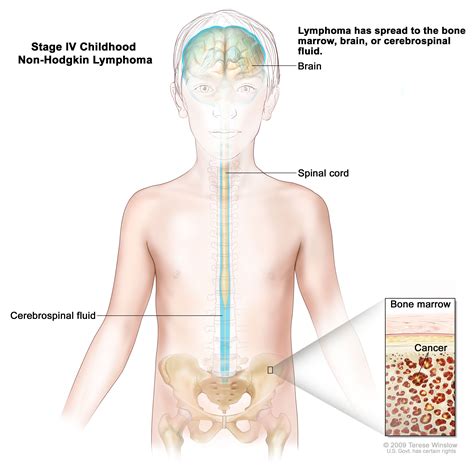 Childhood Non-Hodgkin Lymphoma Treatment (PDQ®)–Patient Version - Siteman Cancer Center