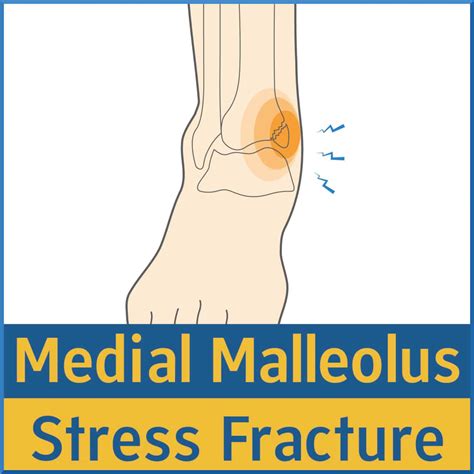 Medial Malleolus Stress Fracture - Sports Medicine Review
