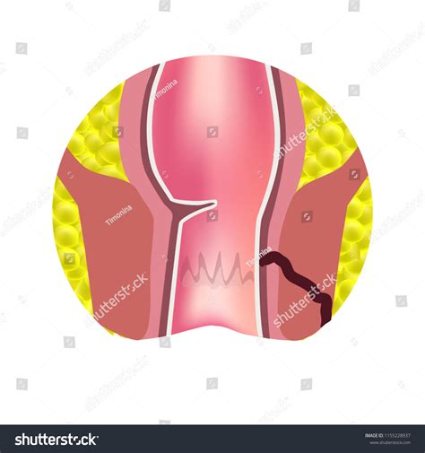 Stock ilustrace „Types Fistulas Rectum Paraproctitis Anus Abscess ...