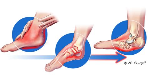Charcot Arthropathy Symptoms and Initial Stage - Orthofix