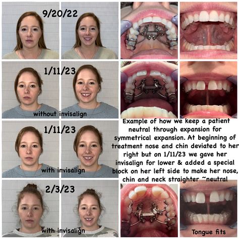 Palate Expander Before And After