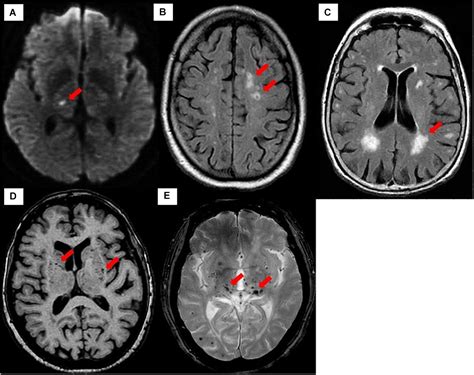 Frontiers | Cerebral Small Vessel Disease (CSVD) – Lessons From the ...