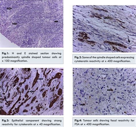 Sarcomatoid Carcinoma of Prostate: A Rare Entity
