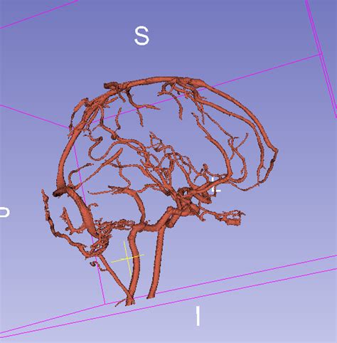 Image result for 3D Slicer Segmentation Tutorial