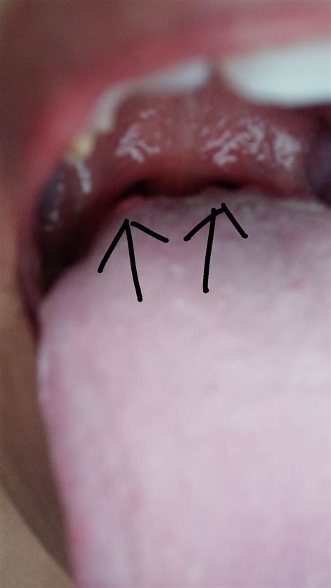Painless bumps on tounge now : r/DermatologyQuestions