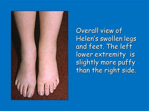A Female Teen with Swollen Feet | Patient Care Online