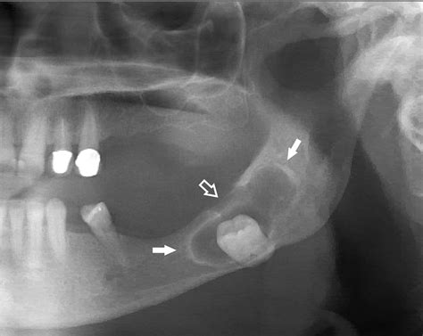 Radiographic Appearance Of Cysts Part 3 And Scintigraphy