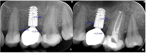 Radiological and Periodontal Evaluation of Stock and Custom CAD/CAM ...