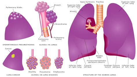 Blebs In Lungs