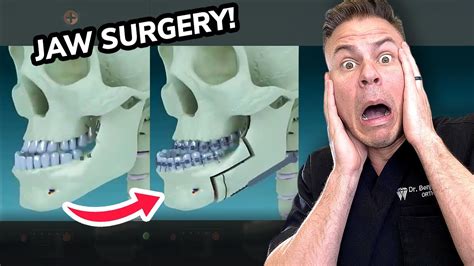 You Won't Believe What REALLY Happens In Jaw Surgery! - YouTube