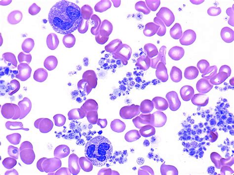 Thrombocytosis definition, causes, symptoms, diagnosis & treatment
