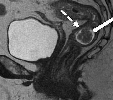 MRI of Rectal Cancer: Tumor Staging, Imaging Techniques, and ManagementRadioGraphics