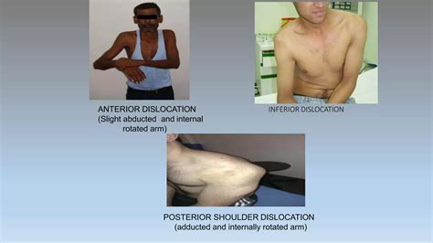 Image result for Shoulder Reduction Methods