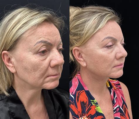 CO2 Laser Face Resurfacing Before & After Photos | Mansher Singh, MD