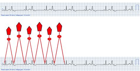 Image result for PVC Localization Chart