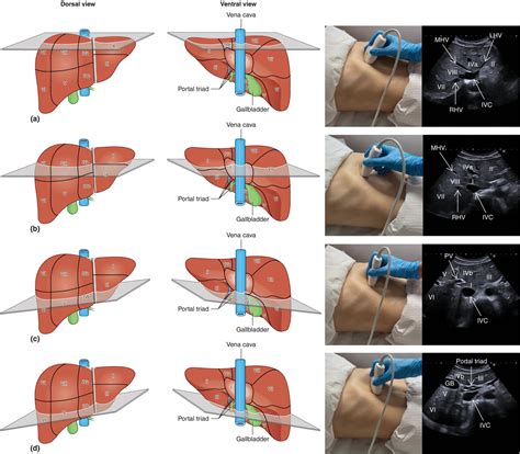 The Radiology Assistant Liver Segmental Anatomy The Radiology