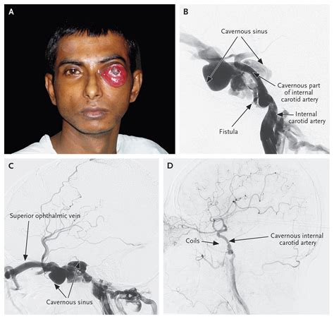 Cavernous Sinus Fistula