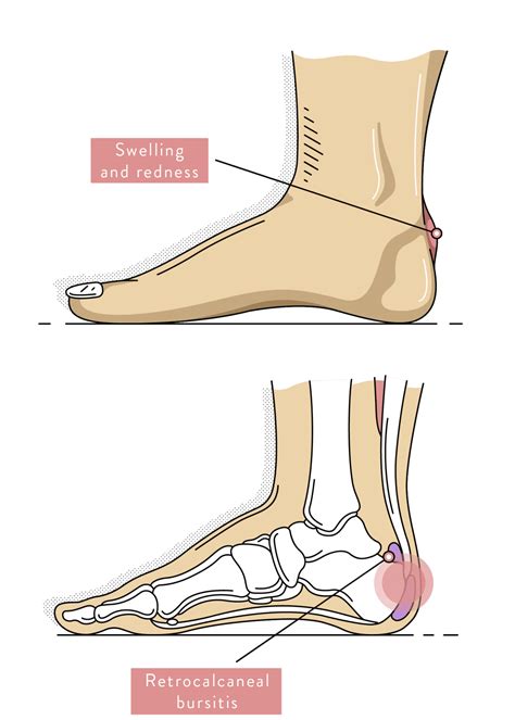 Pain At Back Of Heel