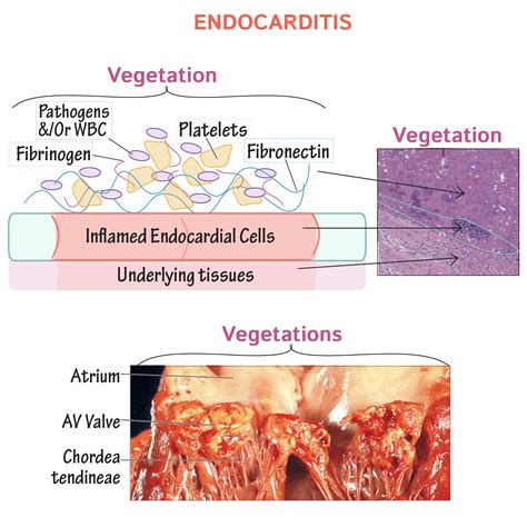 Clinical Pathology Glossary: Endocarditis | ditki medical & biological ...