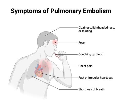 Symptoms of Pulmonary Embolism | BioRender Science Templates
