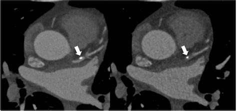 Coronary Artery Calcification: Current Concepts and Clinical ...