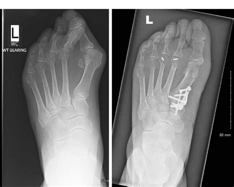 Bunionette X Ray