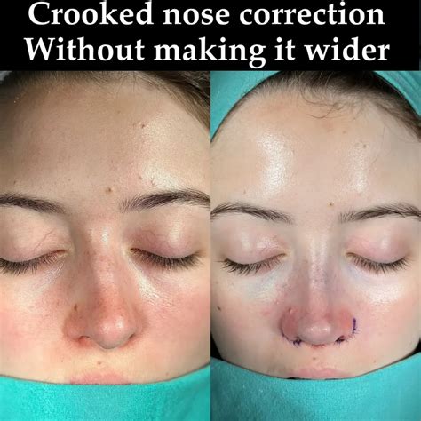 Septoplasty Before and After - Before After Journey