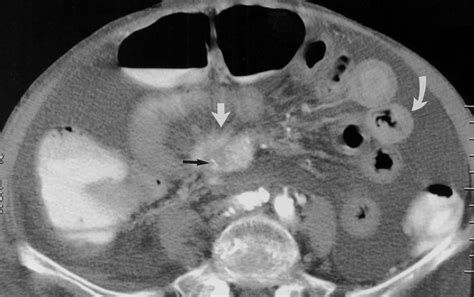 CT of Bowel Wall Thickening Significance and Pitfalls of Interpretation | AJR