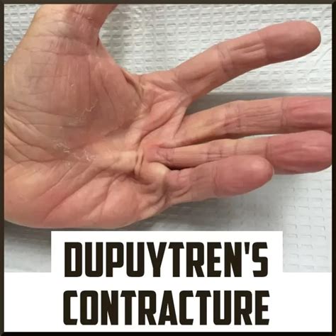Dupuytren's contracture splint - Physical Therapy Treatment and Exercise