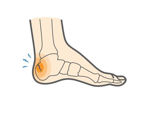 What Is a Calcaneal Stress Fracture & How Do You Recover?