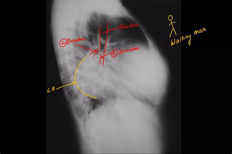 Mitral Regurgitation - ECG , Chest X- Ray | PDF
