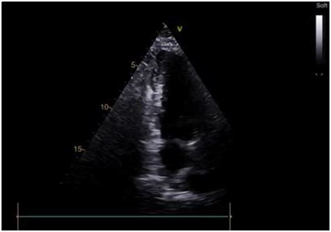 Transapical Approach to Septal Myectomy for Hypertrophic Cardiomyopathy