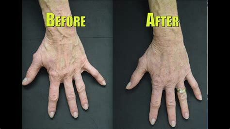 How To Get Rid Of Veiny Hands - Permissioncommission