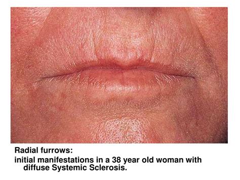 Image result for Diffuse Systemic Scleroderma