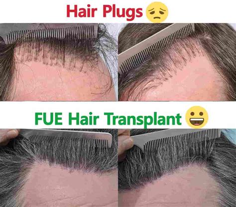Hair Transplant Vs Plugs at Frank Jimenez blog
