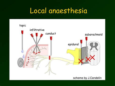 Surface Anesthesia 的图像结果