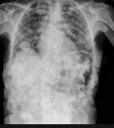 A rare case of diffuse neurofibroma with diaphragmatic eventration:BMC