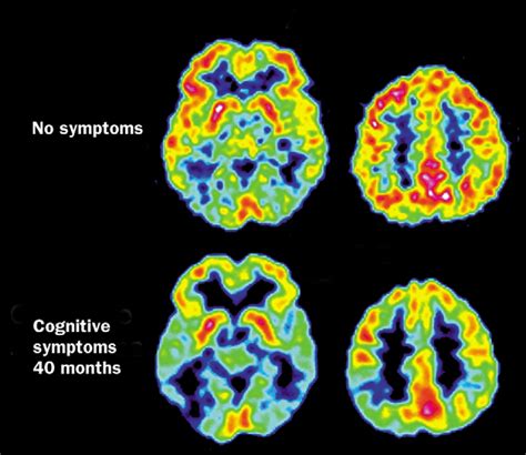 PET imaging of amyloid in Alzheimer's disease - The Lancet Neurology