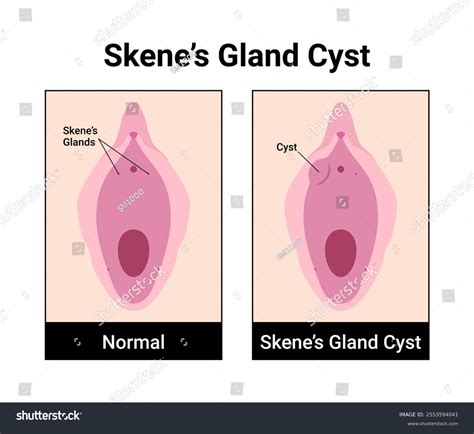 Skenes Gland Cyst Medical Vector Illustration Stock Vector (Royalty ...