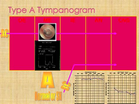 Bilateral Type A Tympanogram at Edward Acosta blog