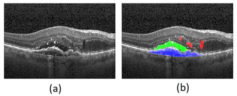 Prognostic Optical Coherence Tomography Biomarkers in Neovascular Age-Related Macular Degeneration