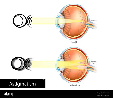 Astigmatic Eye and Normal Eye. Astigmatism, refractive or refraction error. Multiple Focal point ...