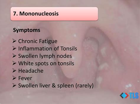 PPT - 8 Causes of White Spots On Tonsils You May Not Know PowerPoint Presentation - ID:7321615