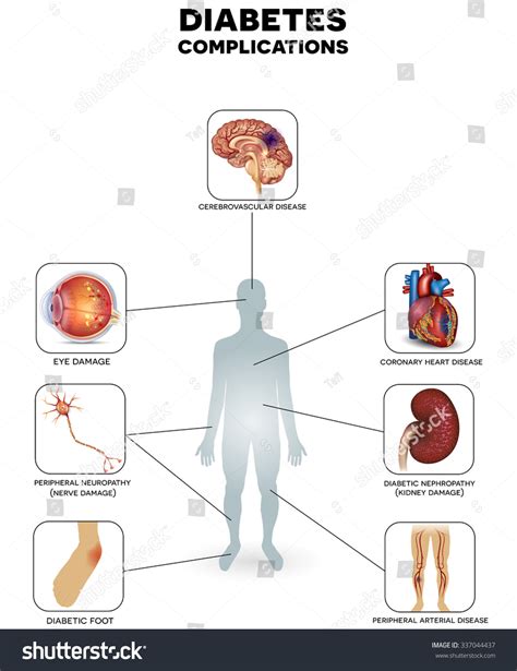 323 Kidney Complications Images, Stock Photos & Vectors | Shutterstock