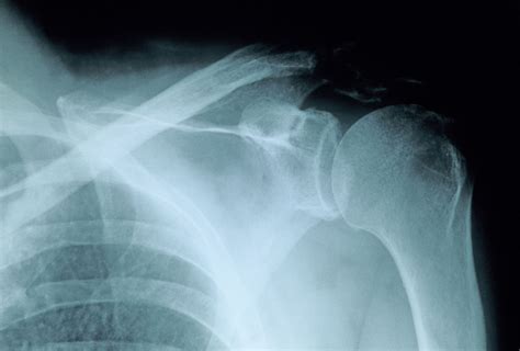 Proximal Humerus Fracture X Ray
