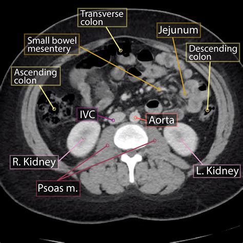 Gross Anatomy Glossary: Axial Abdominal CT | ditki medical & biological ...