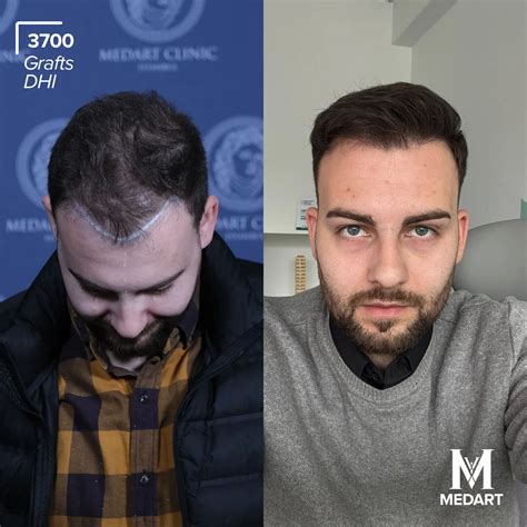 All-Inclusive Turkey Hair Transplant Package with MedArt - Medart Hair